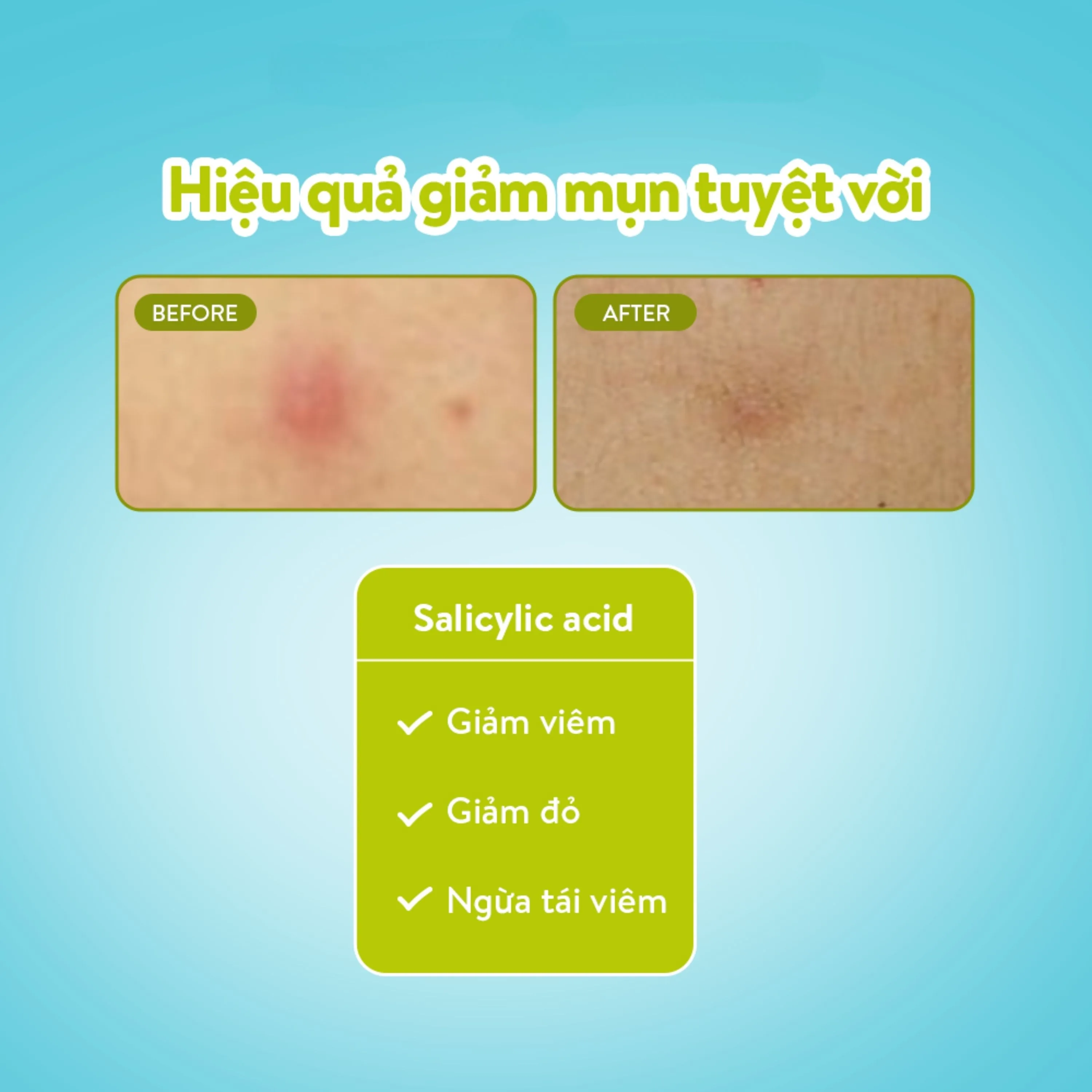 Hình ảnh Miếng dán mụn ban ngày Derma Angel Plus (12 miếng) hút dịch mủ, làm lành vết thương nhanh chóng
